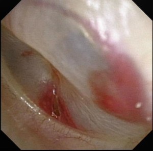 A small tear in the left ear drum caused by a cotton bud