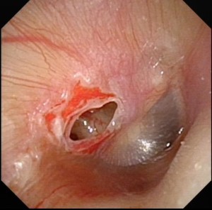 A larger perforation of the right ear drum - this was caused by the sharp end of a comb handle!