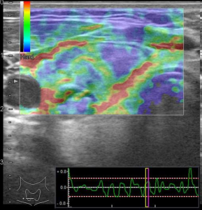 Figure 2: Ultrasound using elastography promises to identify malignant nodules based on their compressibility