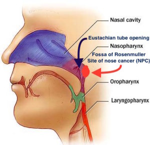 Diagram showing the location where nose cancer arises